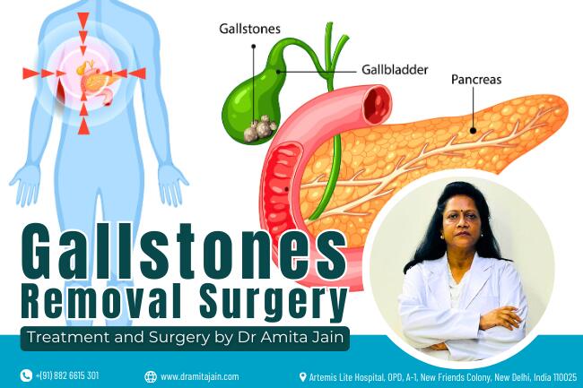 Dr Amita Jain gallbladder stone removal surgeon